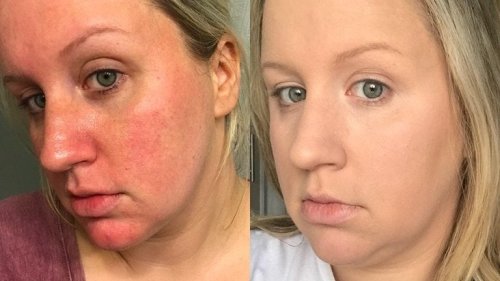 The Internet Is Going Crazy for This Woman's Redness-Concealing Foundation