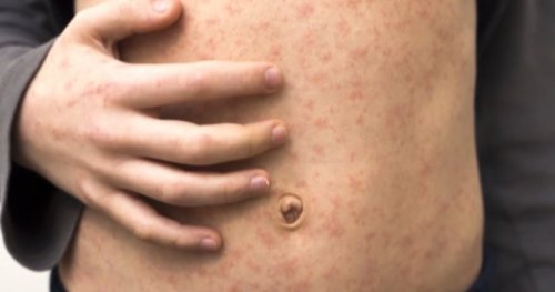 Measles cases in Alberta 6 times higher than other western provinces combined