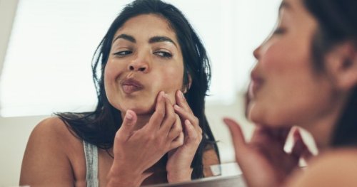 Health Canada should review acne treatment cancer claims: experts