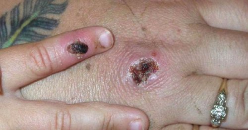 Quebec confirms cases of monkeypox now at 15