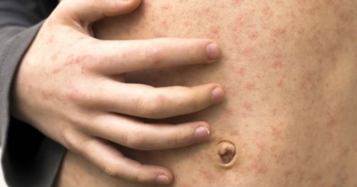 Ontario high school closes after measles exposure reported on campus