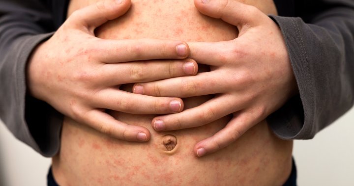 Check your measles vaccination, B.C. urges, as Ontario and Texas outbreaks grow