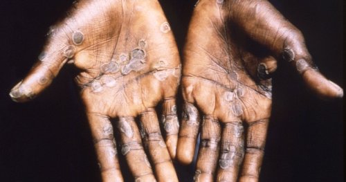 Monkeypox: England detects 36 more cases, bringing total to 56