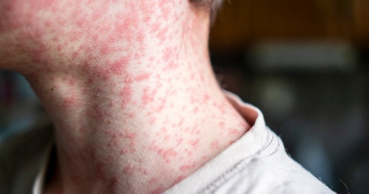Ontario seeing massive spike in measles cases, officials warn of outbreak