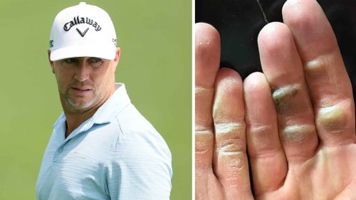 Alex Noren’s gnarled hands went viral. They reveal a lot about the man