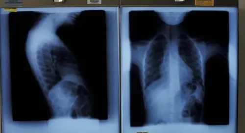 NJ high school student tests positive for tuberculosis