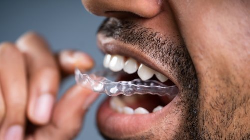 Zahnbleaching zu Hause: Gelbe Zähne trotz putzen?