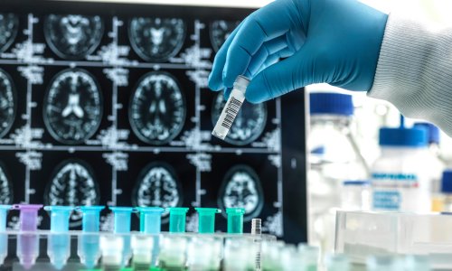 Success of experimental Alzheimer’s drug hailed as ‘historic moment’
