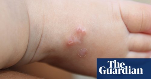 Doctors report ‘nightmare’ surge in scabies across UK