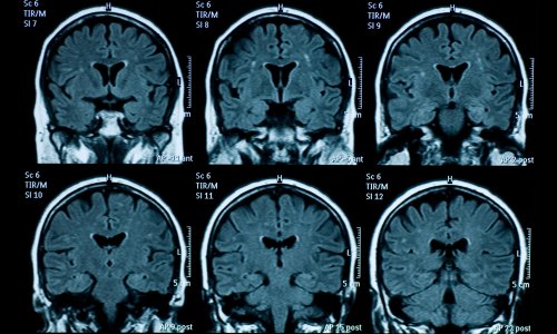 Brains of post-pandemic teens show signs of faster ageing, study finds