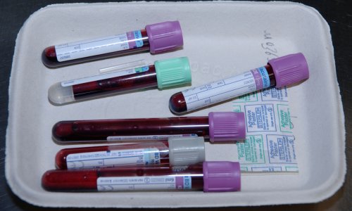 Blood test for 50 types of cancer could speed up diagnosis, study suggests
