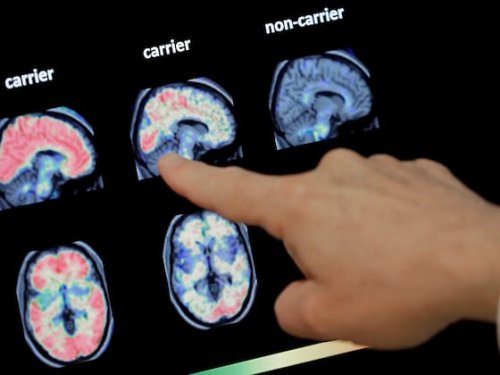 Alzheimer-Forschung gelingt Durchbruch