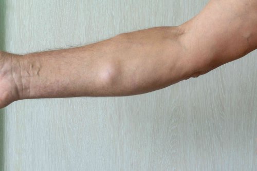 Signs and Symptoms of Lipoma