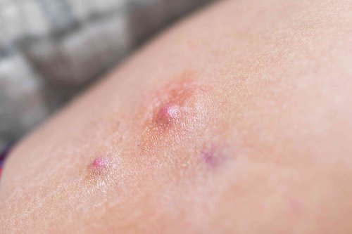 Why Would a Boil Grow on Your Inner Thigh-And What Can You Do About It?