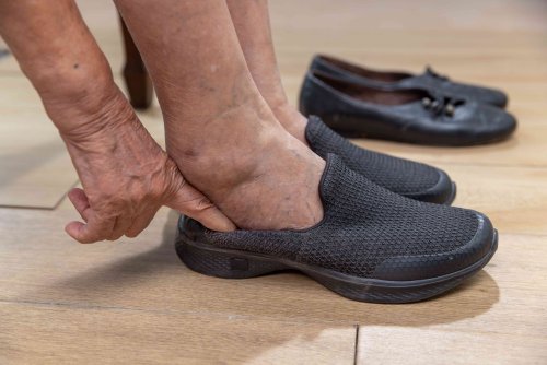Edema (Swelling): Causes, Treatment, and More