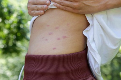 5 Mosquito Bite Relief Tips: Stop the Itch