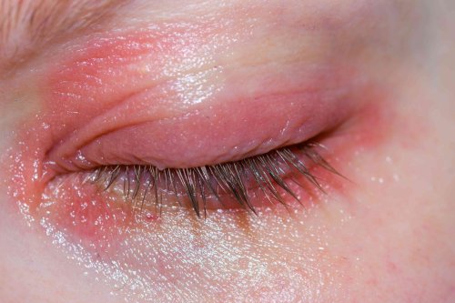 What Is Blepharitis (Eyelid Inflammation)?
