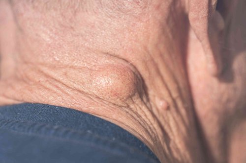 What Is a Lipoma Removal?