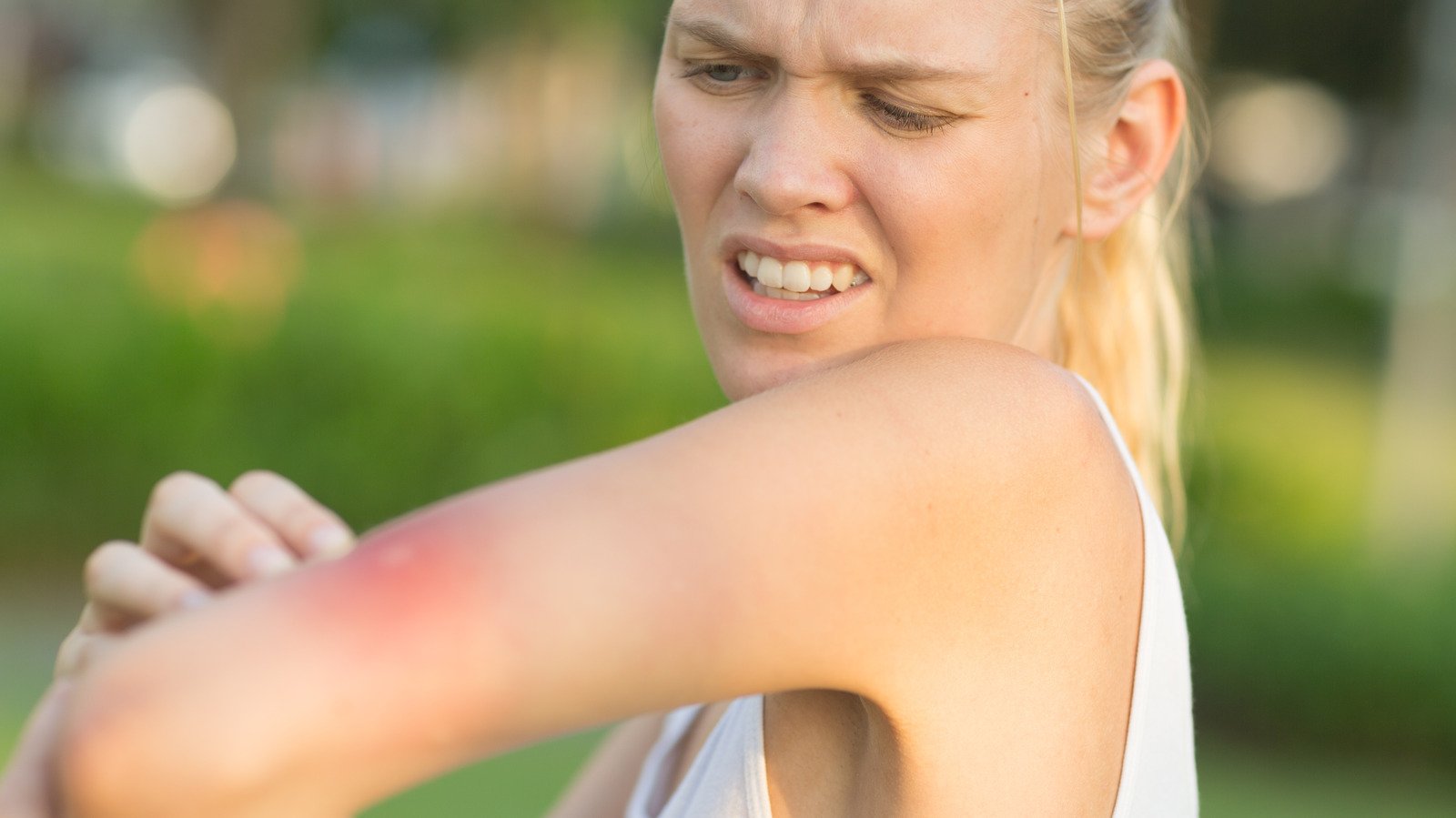 The Most Common Bug Bites To Get In The Summer - Health Digest