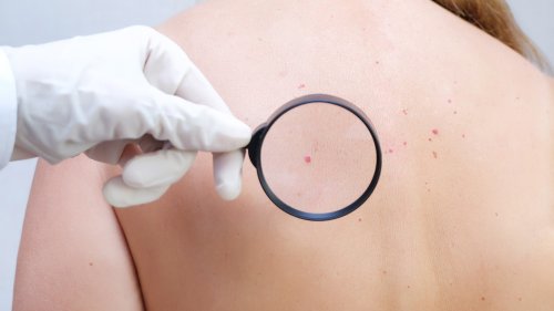 Skin Cancer Explained: Causes, Types, And Treatments