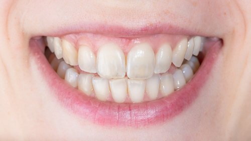 The Real Reason Your Teeth Are Turning Yellow