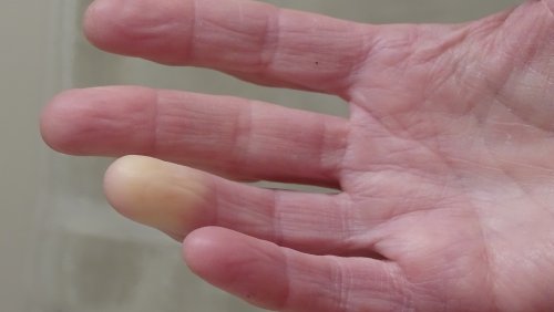 Raynaud's Syndrome Explained: Causes, Symptoms, And Treatments