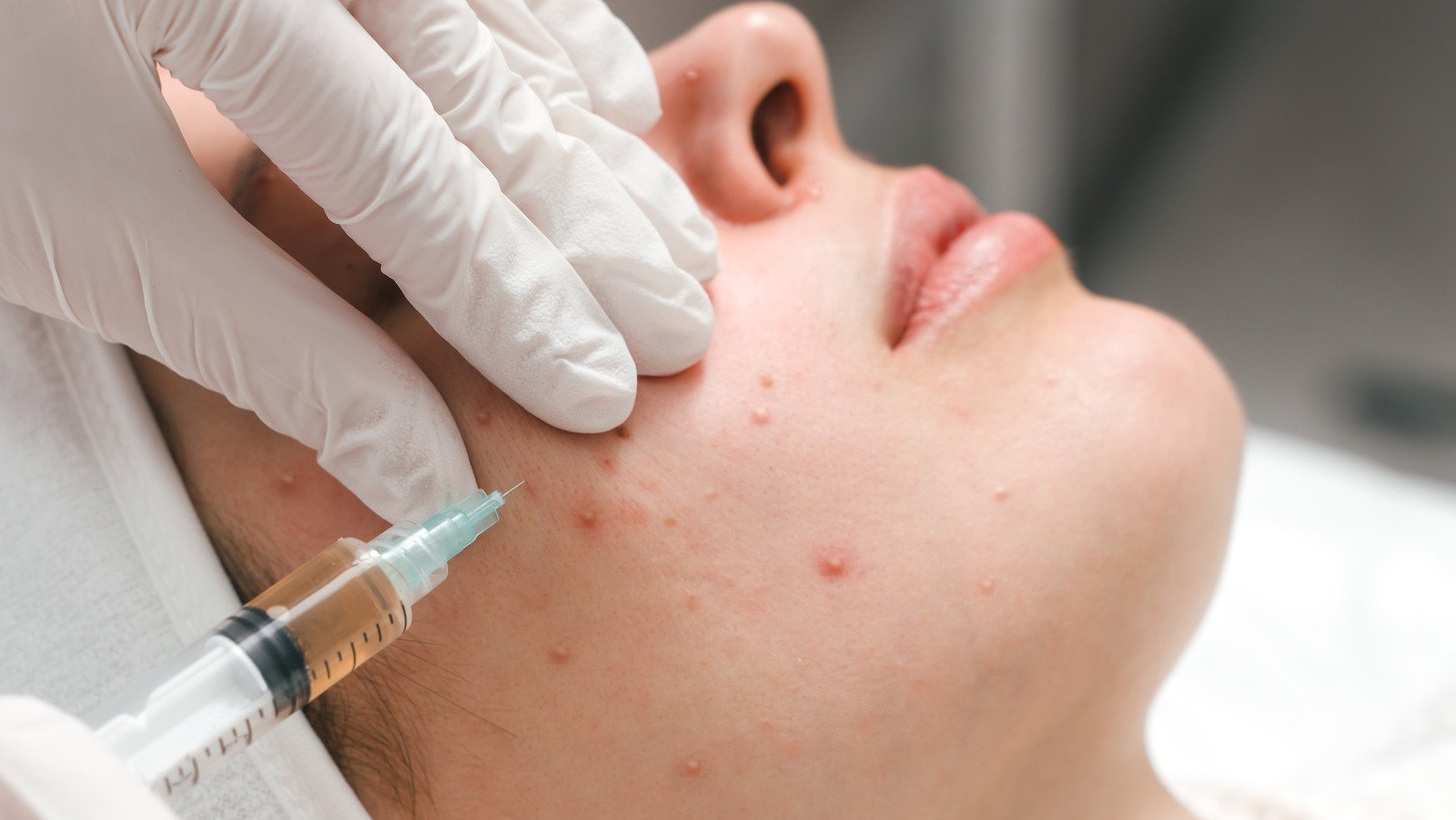 How Cortisone Injections Treat Acne