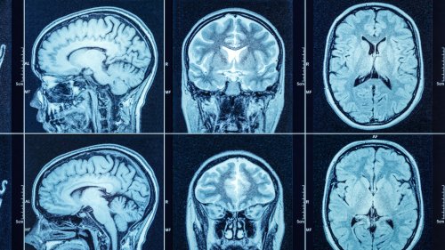 Study Finds COVID-19 May Increase Your Risk Of These Three Neurological Conditions