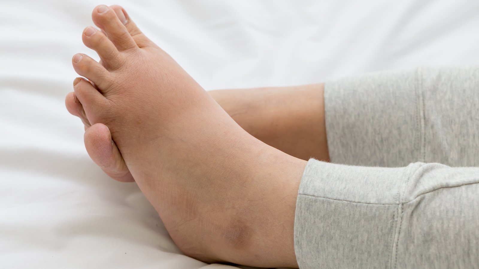 What It Really Means When Your Feet Swell
