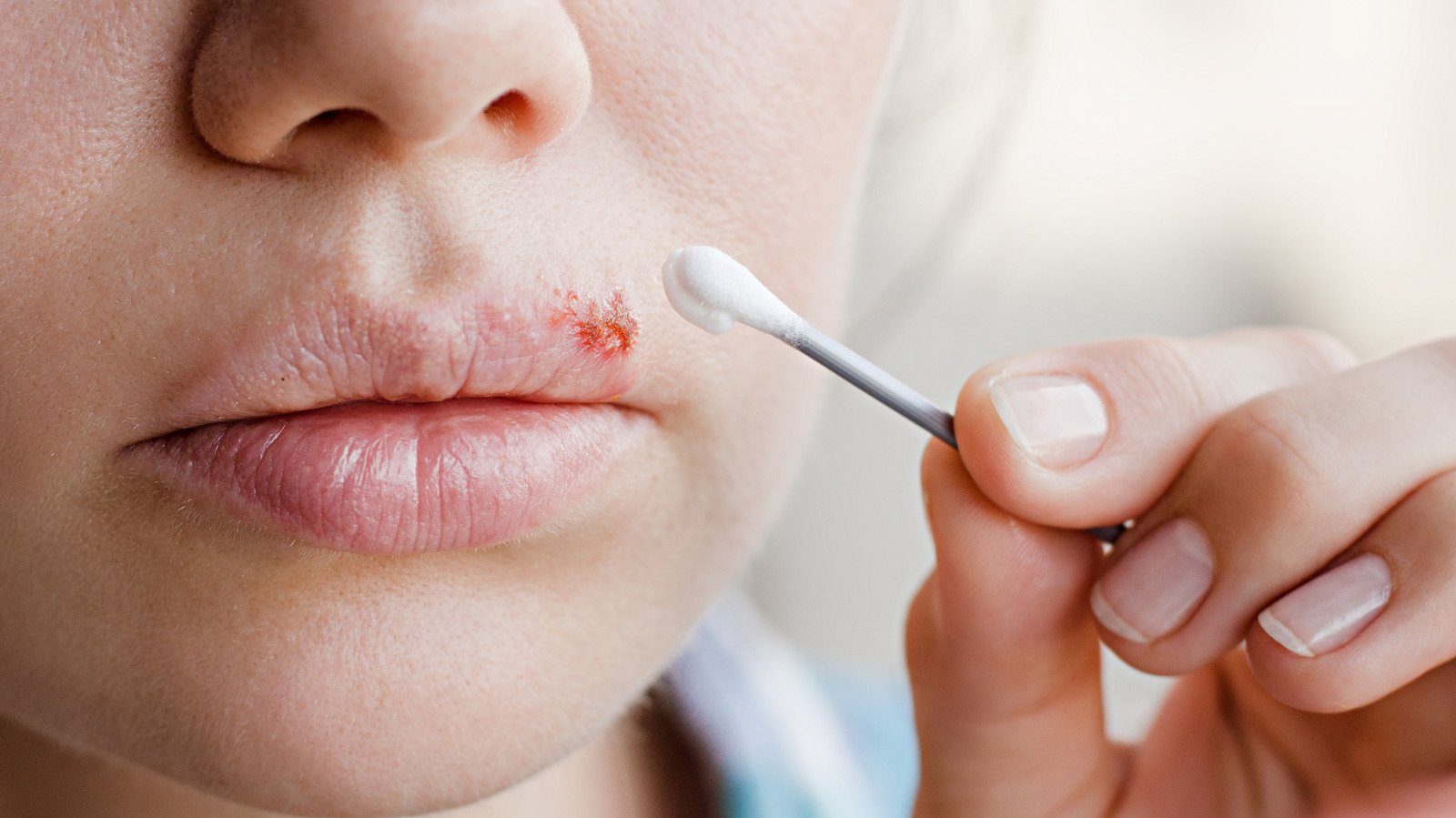 What Really Causes Cold Sores? - Health Digest