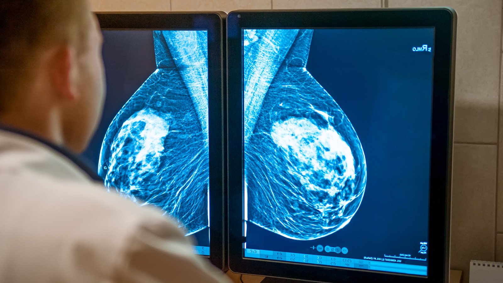 What Your Mammogram Can Tell You About Your Health