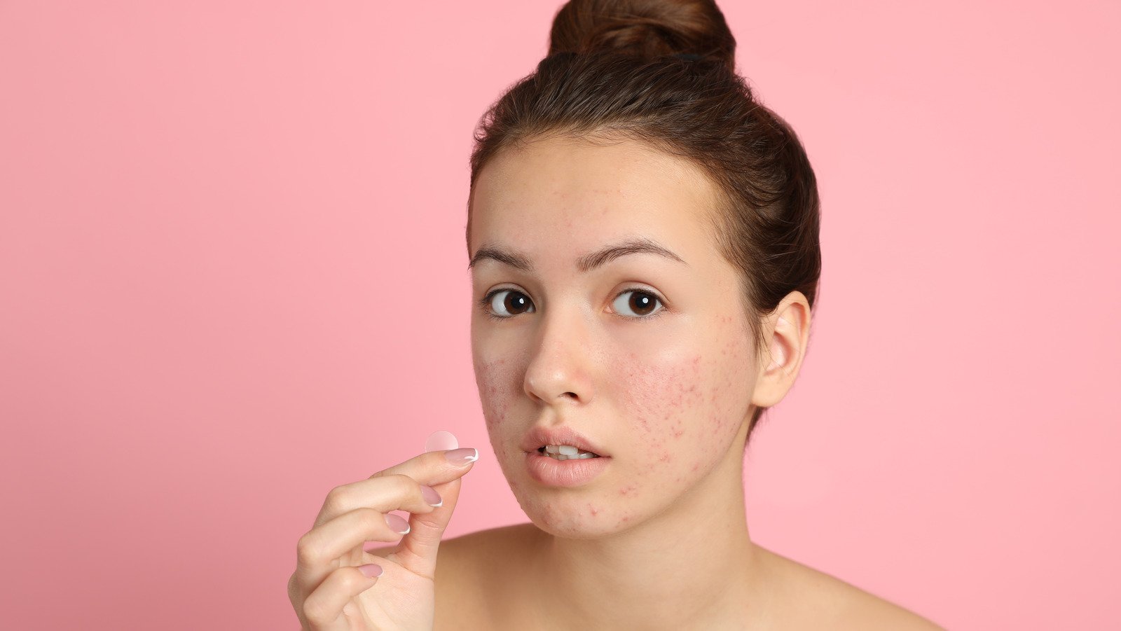 Can You Really Use A Hydrocolloid Bandage To Treat Acne?