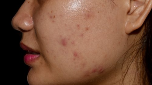 How To Treat Painful Nodular Acne