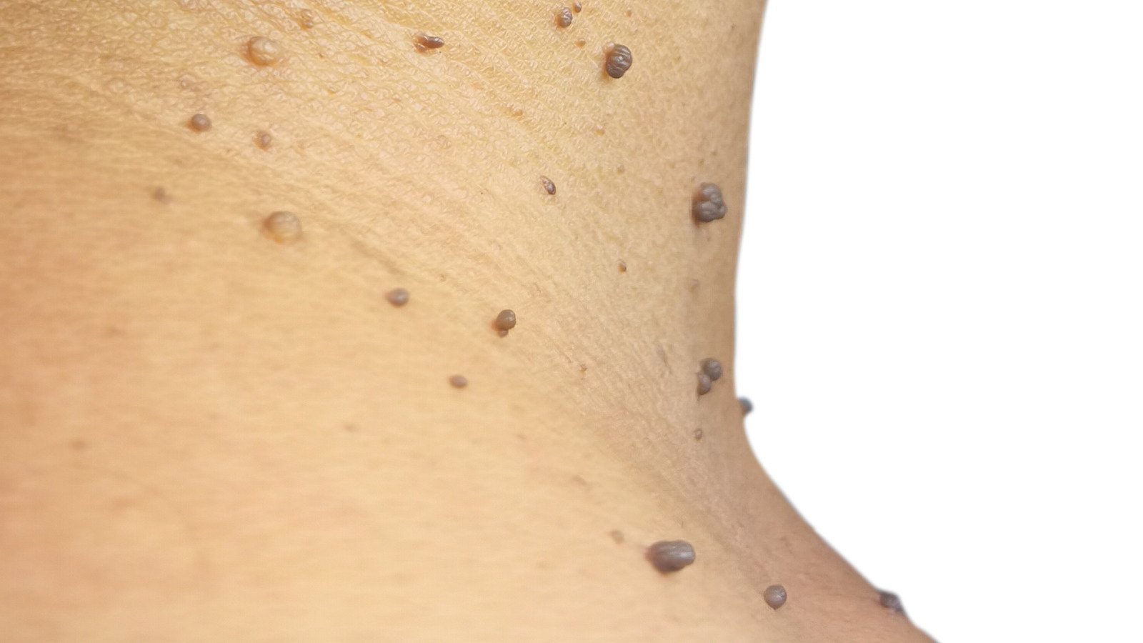What Really Causes Skin Tags?