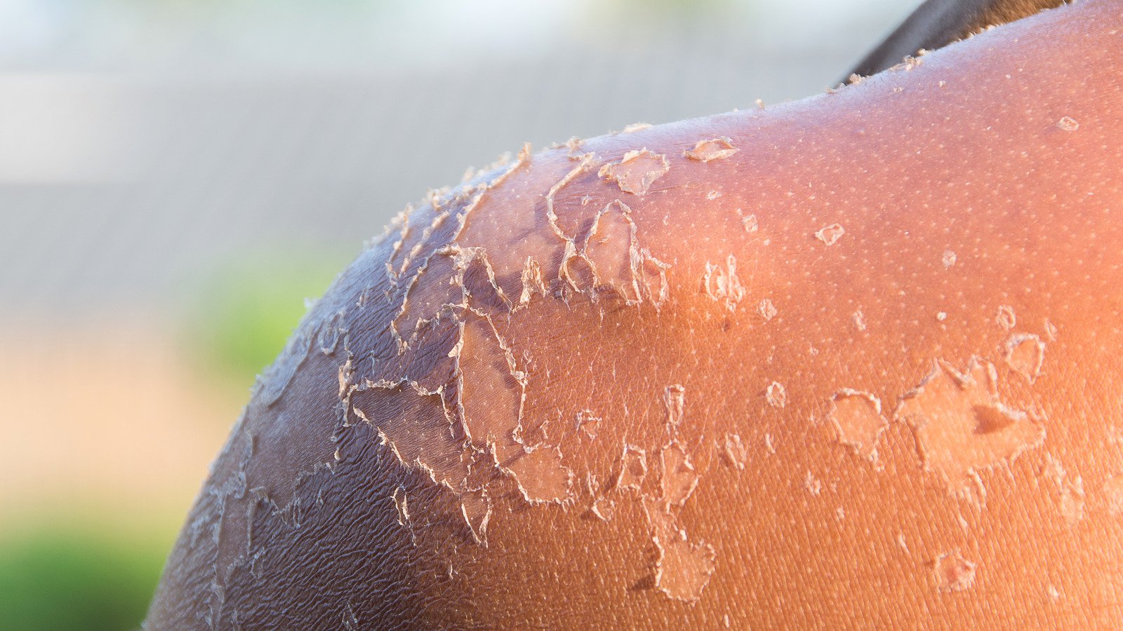 Never Pick Your Skin When It Peels After A Sunburn. Here's Why - Health Digest