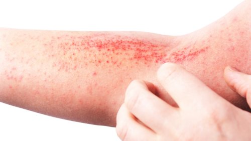 New Research Yields A Game Changing Way To Treat Atopic Dermatitis