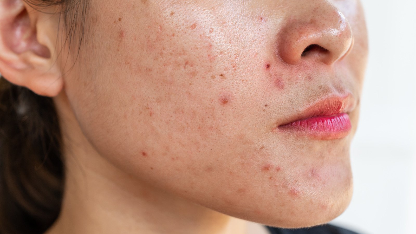 How To Identify The Different Types Of Acne