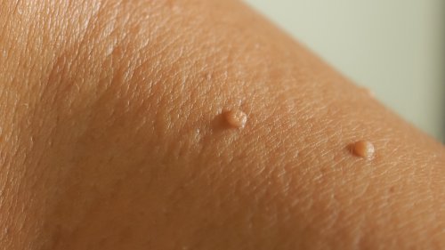 Why You Should Think Twice Before Removing A Skin Tag At Home Flipboard