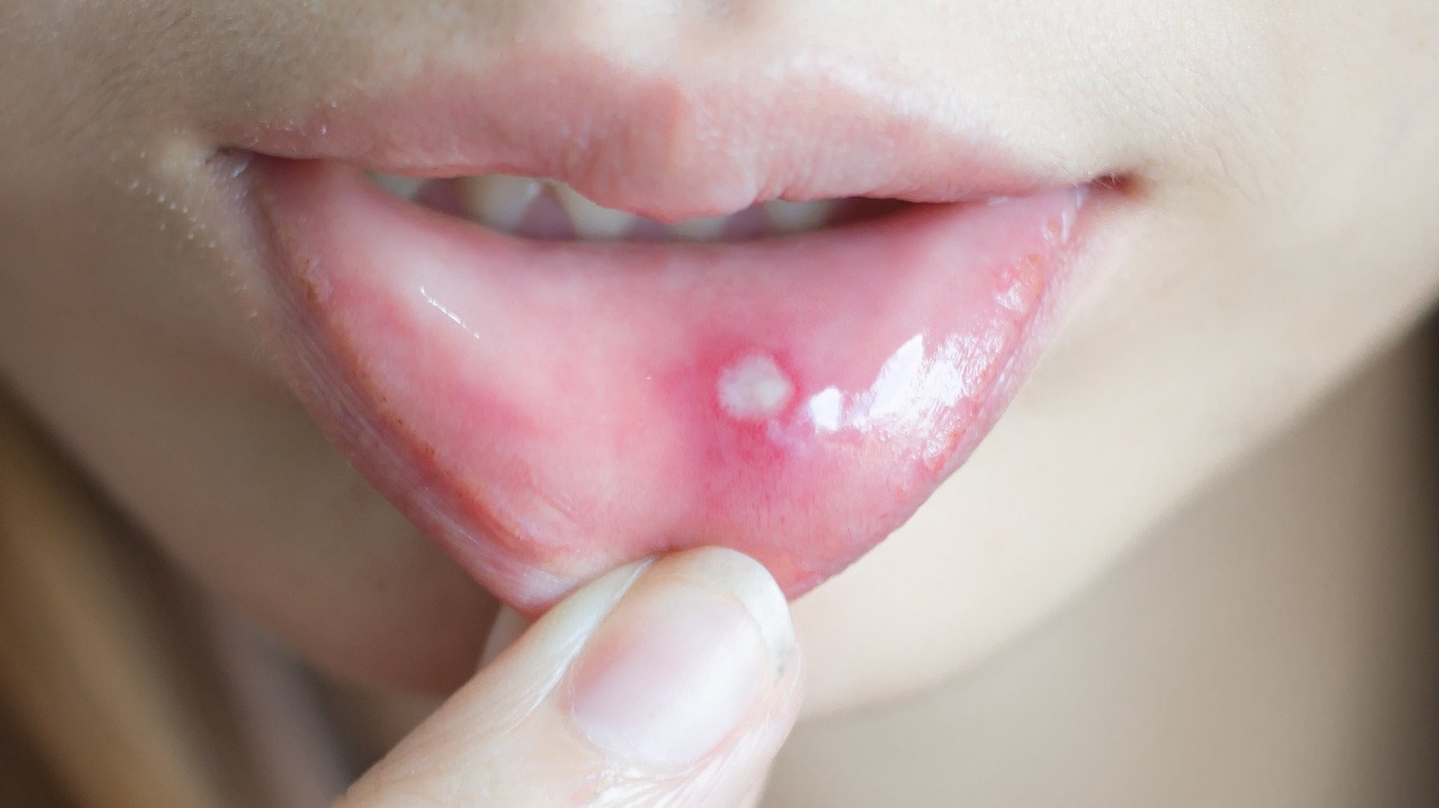 Here's What's Really Causing Your Canker Sores - Health Digest