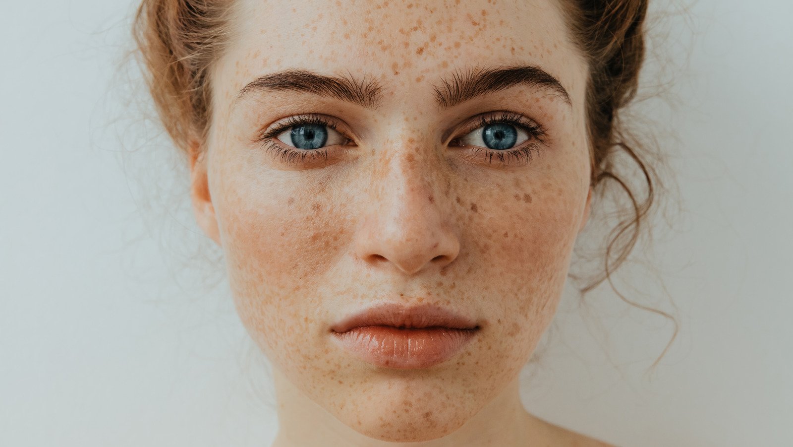 Moles Vs Freckles: What's The Difference? - Health Digest