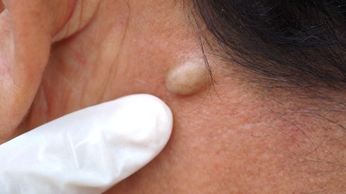 Sebaceous Cysts: The Complete Guide | Flipboard