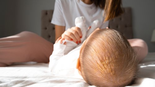 What To Do If Your Baby Has Cradle Cap