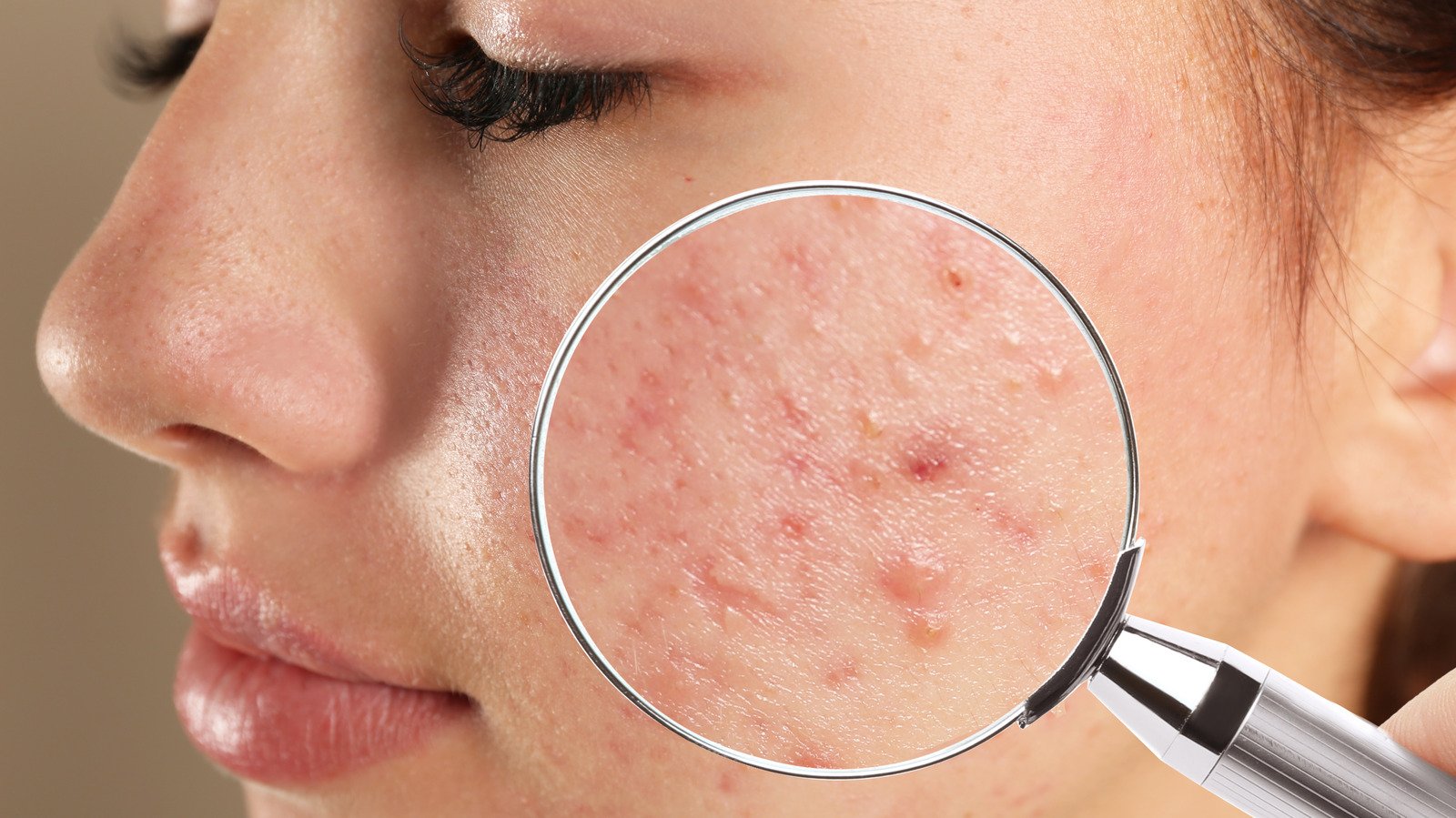 14 Causes Of Acne Flare-Ups You Might Not Know