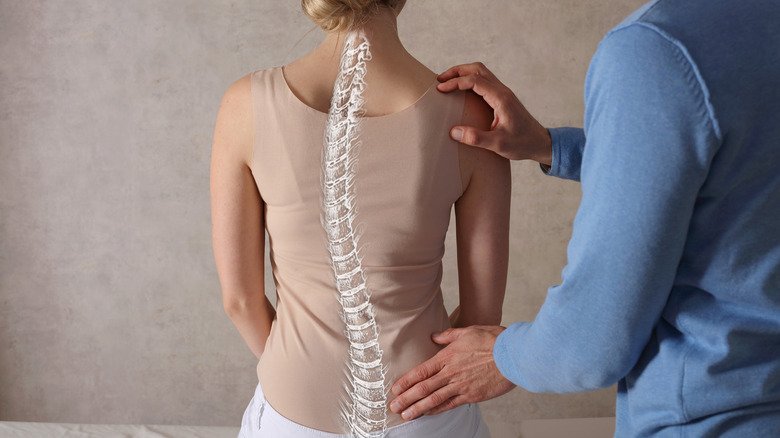 This Is What Really Causes Scoliosis