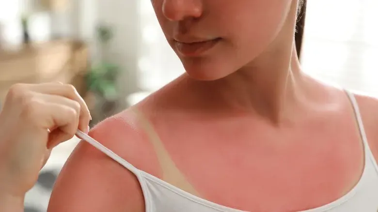 What Really Happens To Your Body When You Get A Sunburn