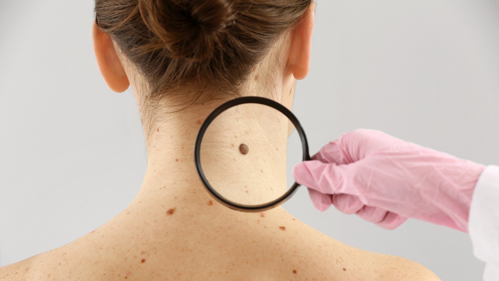 Doctor Explains When You Should Be Concerned About Your Mole