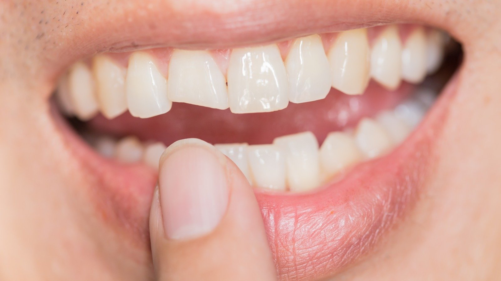 More People Are Having Cracked Teeth Right Now: Here's Why