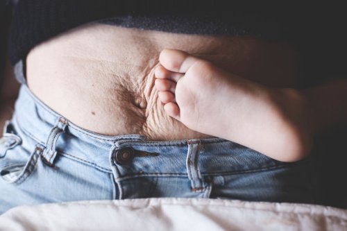 Stretch Marks: Why They Appear & How To Heal Them