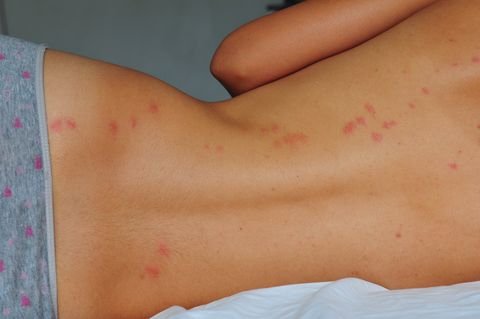 9 Bug Bite Pictures - How To Identify Common Types Of Bug Bites
