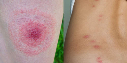 12 Pictures of Common Bug Bites and How to Identify Their Symptoms
